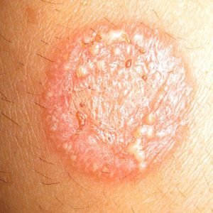 दाद (Fungal Infection)1