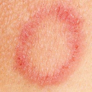 दाद (Fungal Infection)2